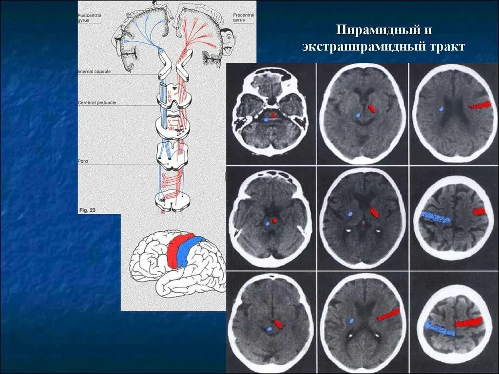 Норма желудочков мозга у взрослых. Пирамидный тракт мрт. Кт анатомия головного мозга. Мрт анатомия головного мозга. Контрастная компьютерная томография головного мозга.