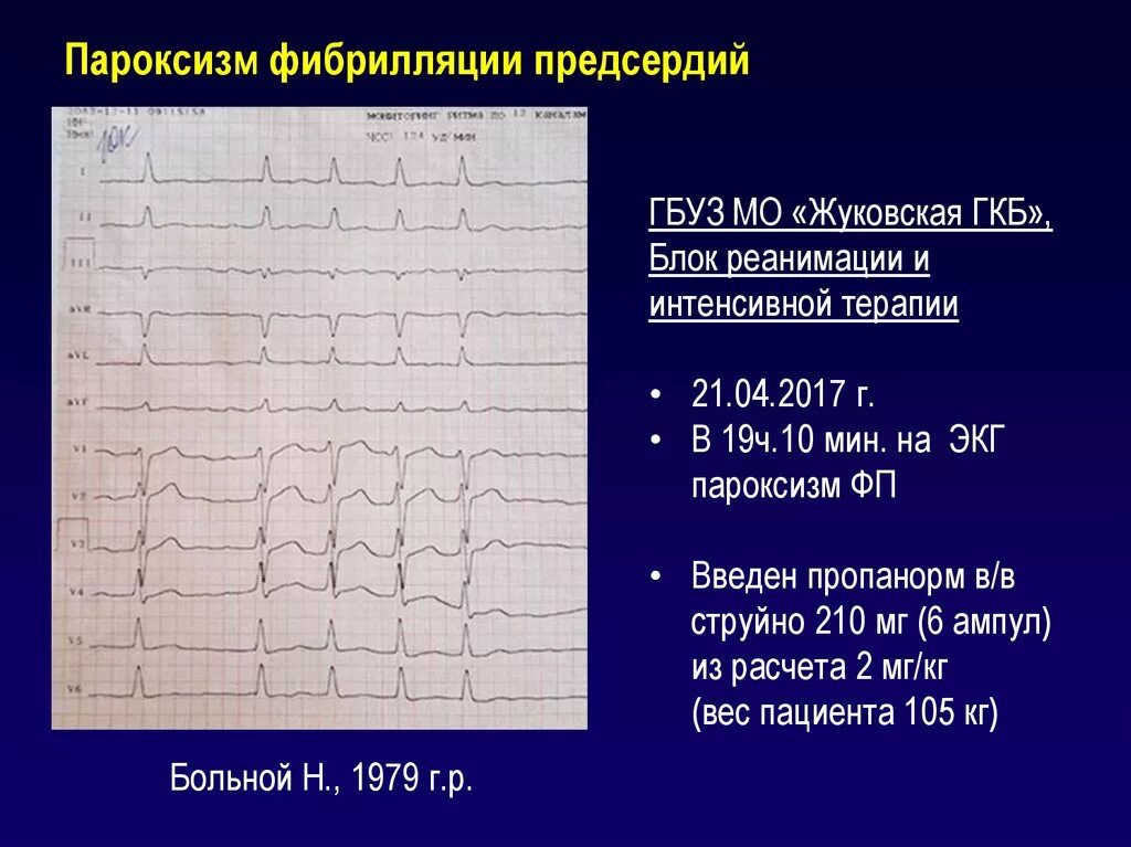 Мерцательная аритмия на ЭКГ пароксизмальная форма. Пароксизмальная форма фибрилляции предсердий ЭКГ. Персистирующая фибрилляция предсердий ЭКГ. ЭКГ при пароксизме фибрилляции предсердий.