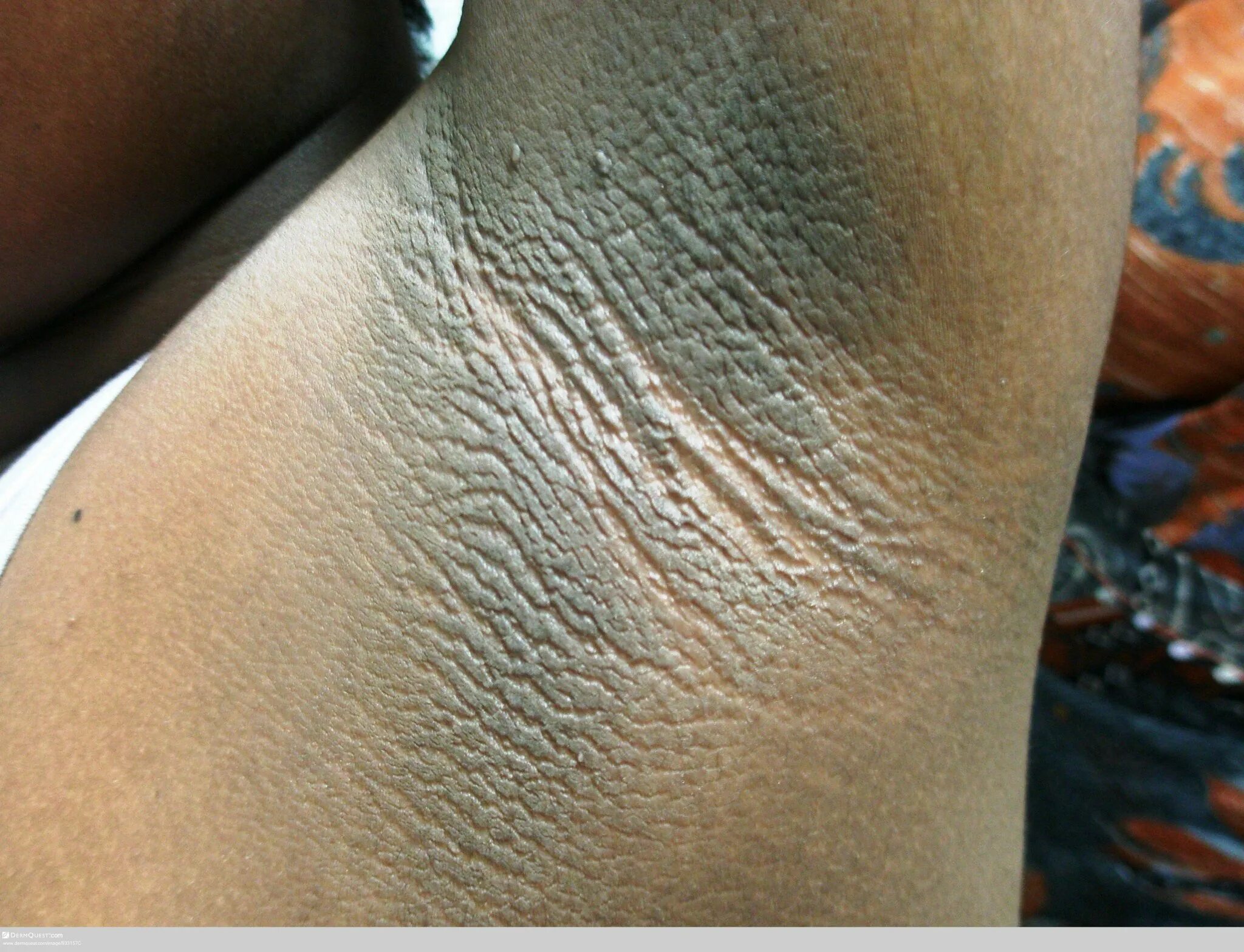 черный акантоз симптомы. почему у женщины между ног темная кожа. черный акантоз (acanthosis nigricans). почему у женщины между ног темная кожа. псевдомикоз.