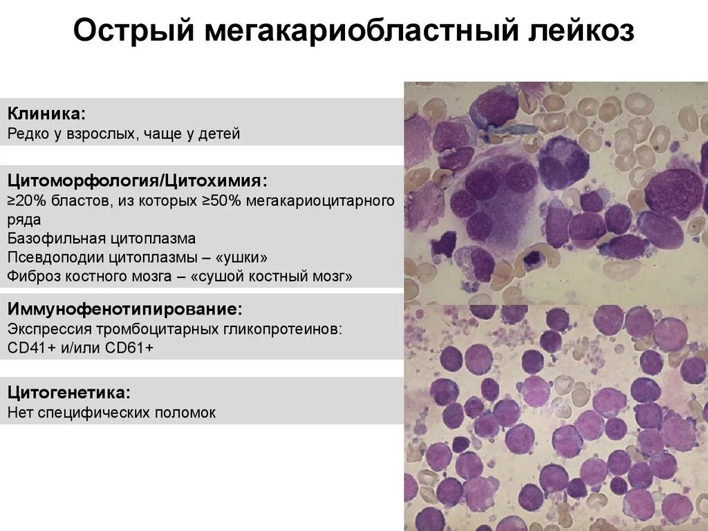 Лейкоз характеризуется. Хронический миелобластный лейкоз гистология. Острый миелобластный лейкоз картина крови. Хронический мегакариобластный лейкоз. Острый мегакариоцитарный лейкоз.