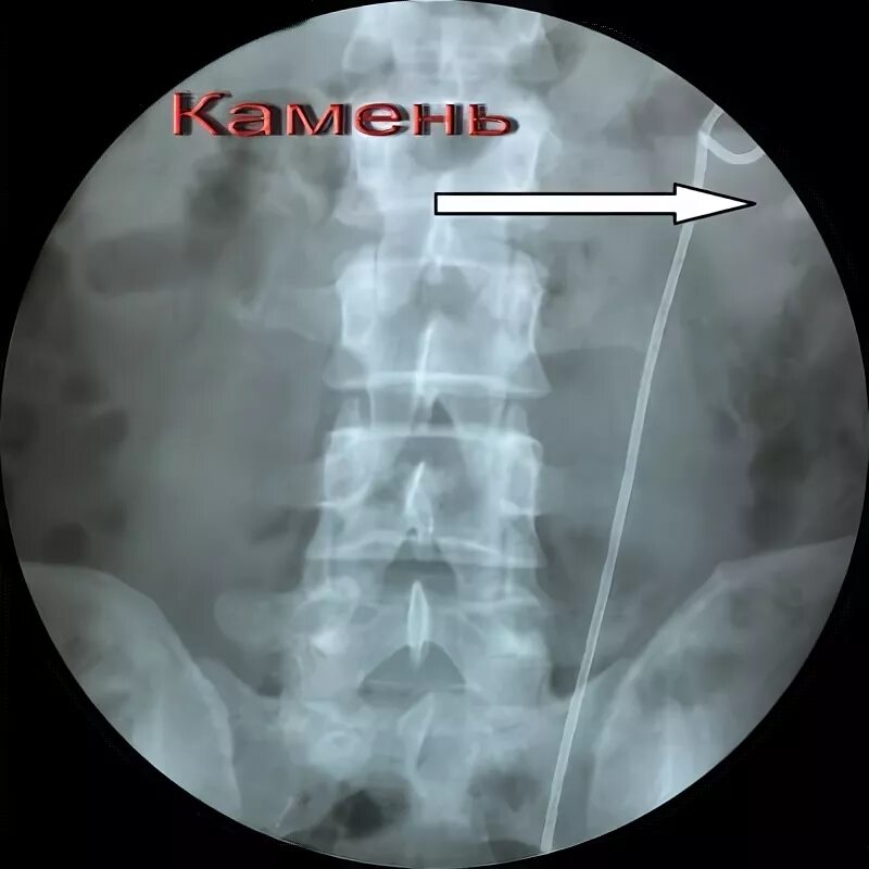 Камень в стенте мочеточника. Стентирования мочеточника. Стенд в мочеточнике рентген. Камень в мочеточнике стент.