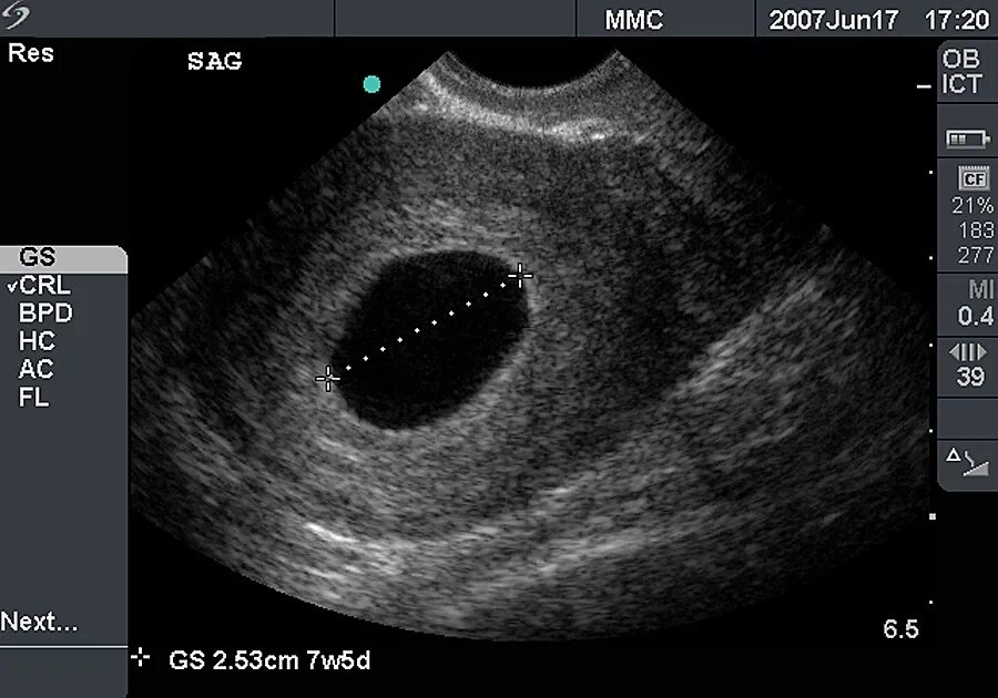 Замершая беременность УЗИ 8 недель. УЗИ 8 недель беременности анэмбриония. Без плодного яйца