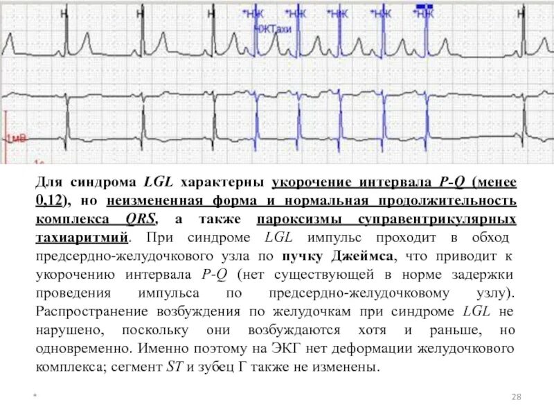 Укороченный интервал pq у взрослых что это. Синдром укороченного интервала pq на экг. синдром укороченного qt на экг. интервал pq при тахикардии. синдром клерка-леви-кристеско экг.