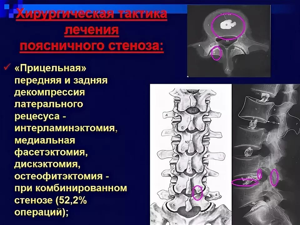 Спинальный стеноз операция