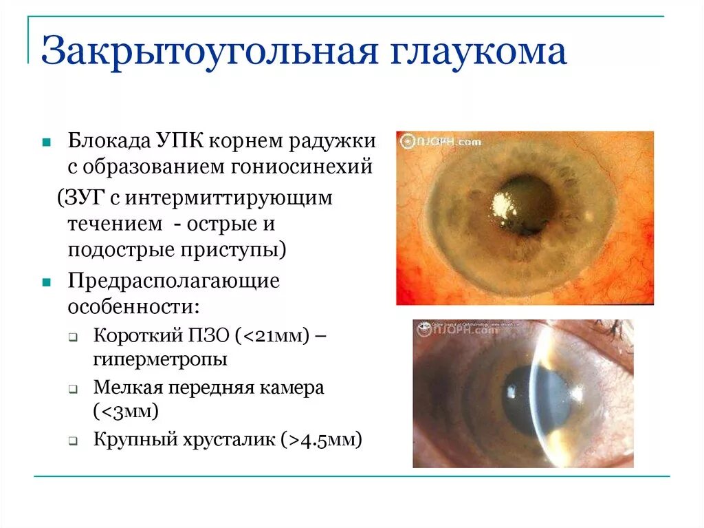 Первичная закрытоугольная глаукома симптомы. Острый приступ закрытоугольной глаукомы. Первичная открытоугольная глаукома симптомы. Закрытоугольная глаукома глаза.