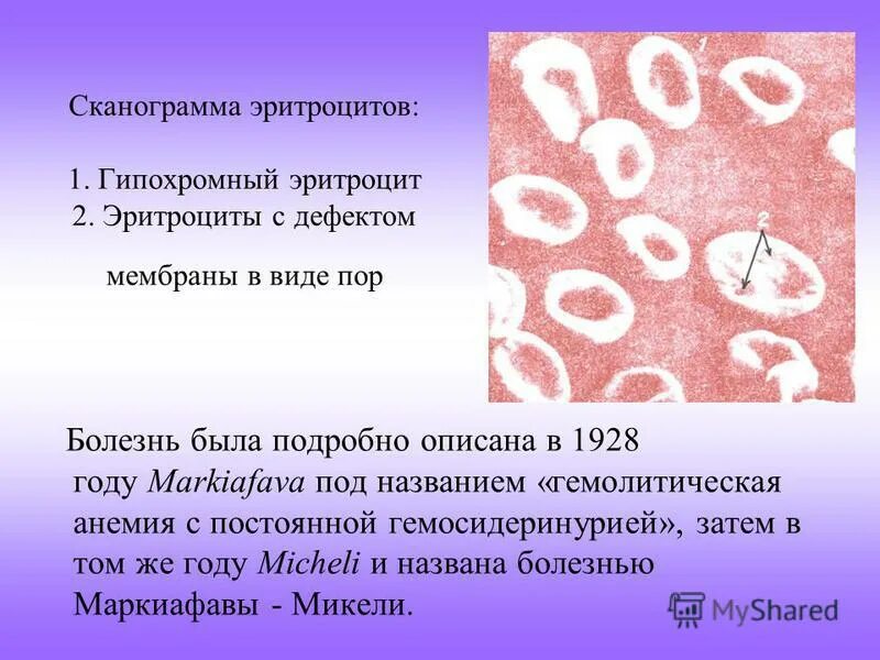 Эритроциты в крови анемия. Hbs серповидноклеточная анемия. Гемоглобин и эритройит. Гемолитическая анемия картина крови. Гемоглобин серповидноклеточная анемия.