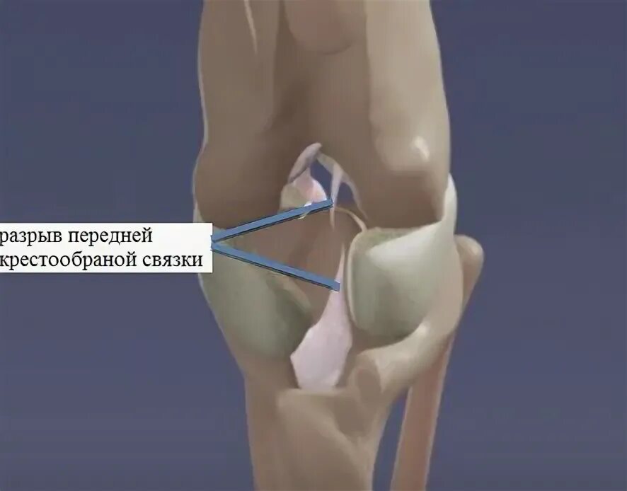 Разрыв связок коленного сустава ПКС операция. Разрыв крестообразной связки коленного сустава у собак. Крестообразная связка коленного сустава у собак. Операция колено пкс