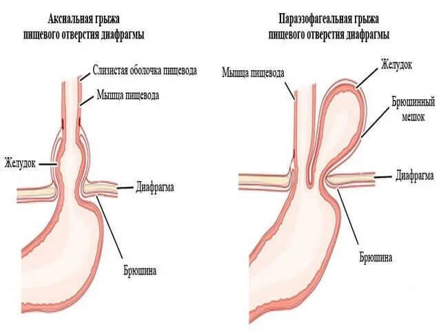 Грыжа под как лечить. Скользящая хиатальная грыжа. Параэзофагеальная скользящая грыжа пищеводного отверстия диафрагмы. Грыжа диафрагмального отверстия пищевода. Хиатальная грыжа диафрагмы.