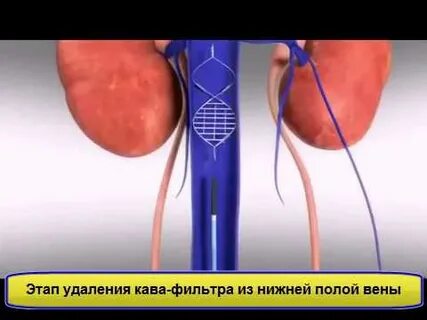 Тромб фильтр