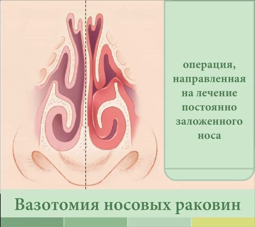 Нижняя подслизистая вазотомия. Операция лазерная вазотомия. Вазотомия нижних носовых раковин. Подслизистая вазотомия носовых.