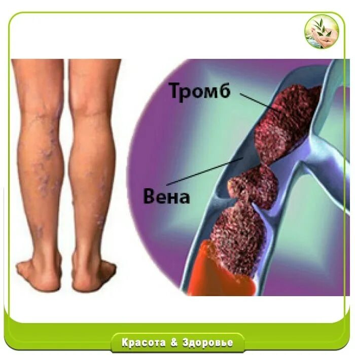 Флеботромбоз вен