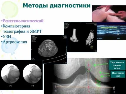 Остеоартроз тест