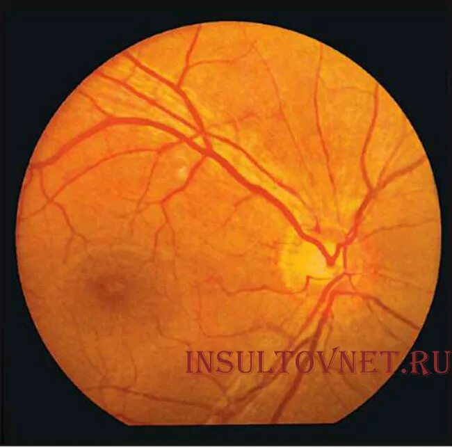 Болезнь глазного дна. Ангиопатия сетчатки глазное дно. Ангиосклероз сетчатки глаза что это такое. Гипертонический ангиосклероз сетчатки. Ангиоспазм сетчатки глазное дно.