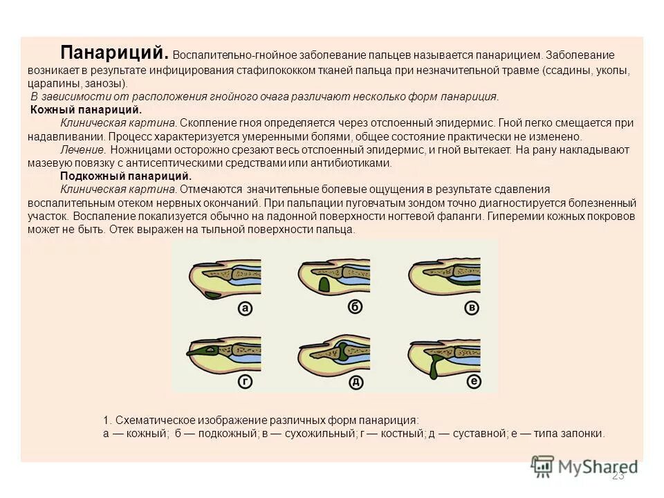 Панариция какими мазями лечить. Подкожный панариций антибиотики. Антибиотики при панариции пальца.