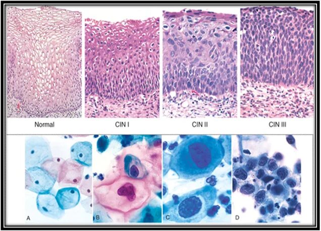 Дисплазия шейки матки Cin 1-2. Группы клеток метаплазированного