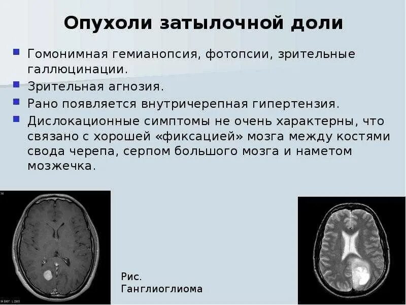 Образование в лобной доле. Опухоль мозга височной доли симптомы. Опухоли затылочной доли симптомы. Опухоли заылочной дольки. Опухоль затылочной доли головного мозга.