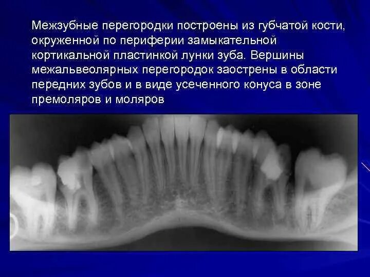 Межкорневые перегородки зуба. Межзубная перегородка костная. Пародонтит, гингивит, периодонтит. Межзубные костные перегородки. Межзубная перегородка костная.