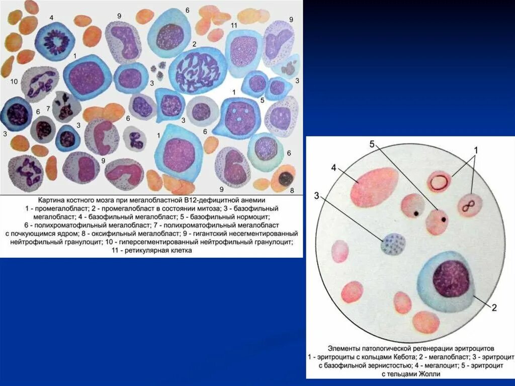 Костный мозг при мегалобластной анемии. Мегалобластная анемия картина крови. Мегалобласты и мегалоциты. Костный мозг при в12 дефицитной анемии. Тельце гейнца
