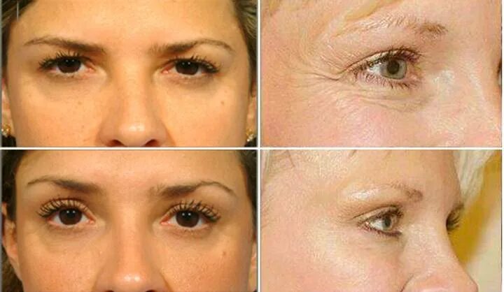 Микротоки лицо до и после фото отзывы. Микротоки для век до и после. эффект от микротоков для лица. микротоки для лица результат. микротоки вокруг глаз до после.