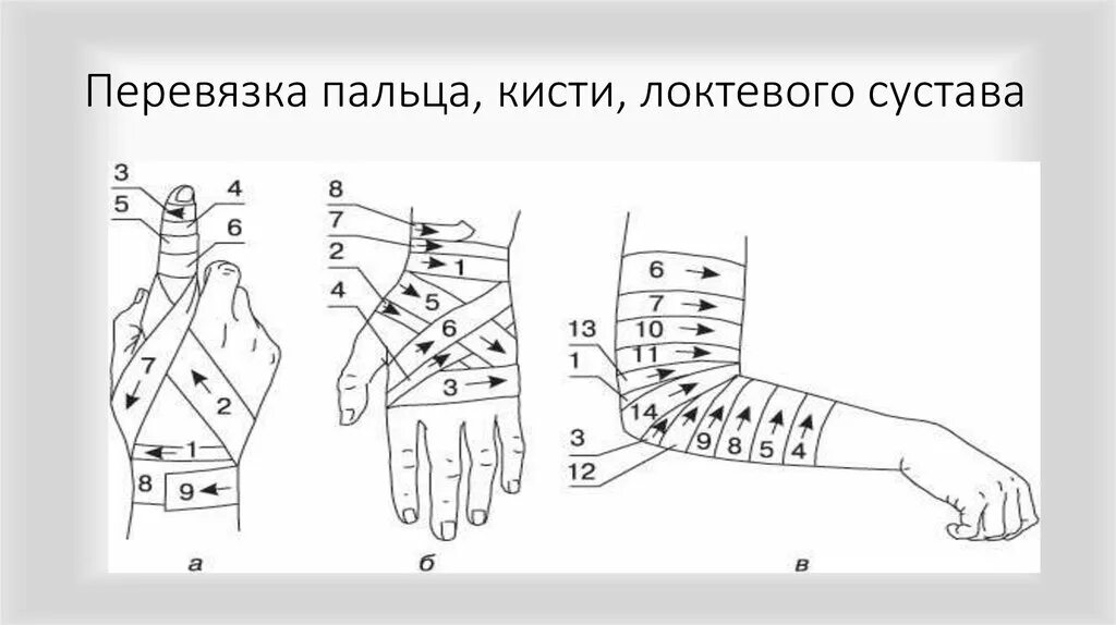 Перевязка кисти. Схема перевязки кисти. Перевязка большого пальца на руке. Как перевязать кисть