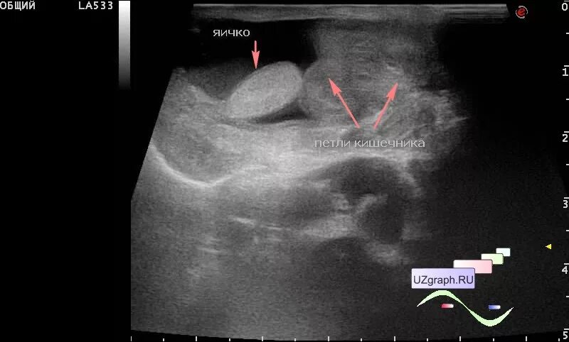 Пахово-мошоночная грыжа на УЗИ протокол. Грыжа пахового канала на УЗИ. Паховово -мошоночная грыжа сузи. Ущемленная паховая грыжа на УЗИ. Можно увидеть грыжу на узи