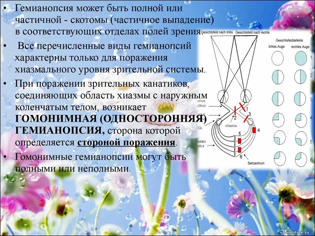 Выпадение квадранта поля зрения. Левосторонняя гемианопсия поля зрения. Гетеронимная гемианопсия возникает при поражении. Левосторонняя гемианопсия поля зрения. Биназальная гемианопсия причины.