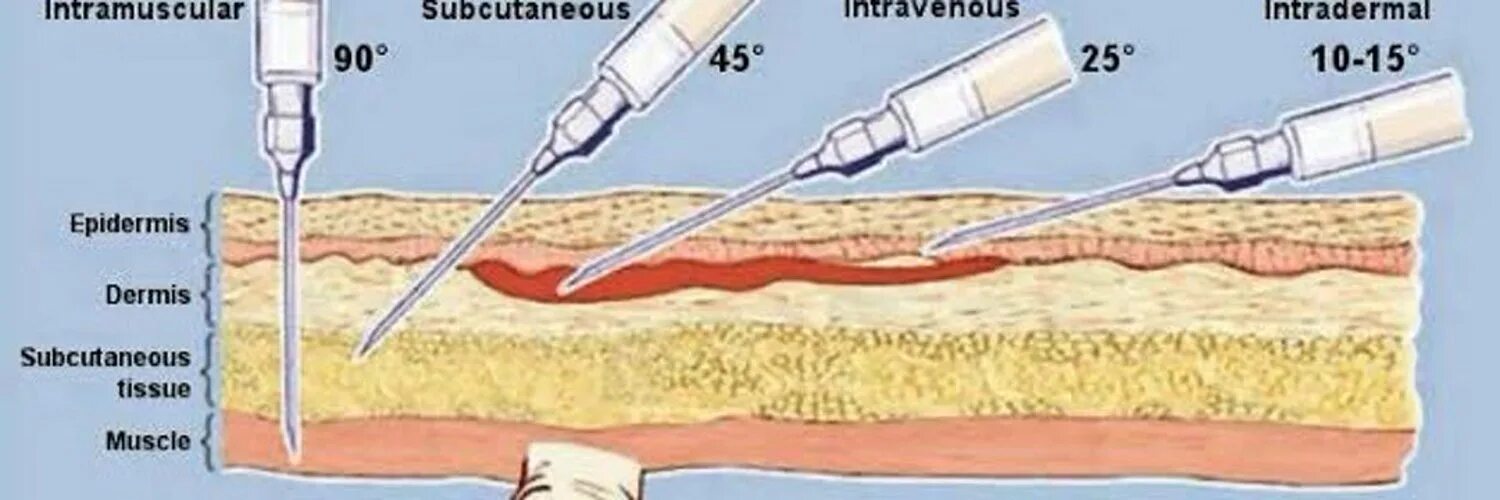 Введение иглы при внутримышечной инъекции. Внутрикожная инъекция угол наклона иглы. Угол введения иглы при внутримышечной инъекции. Угол иглы при внутрикожной инъекции в градусах. Угол введения иглы при внутрикожной инъекции.