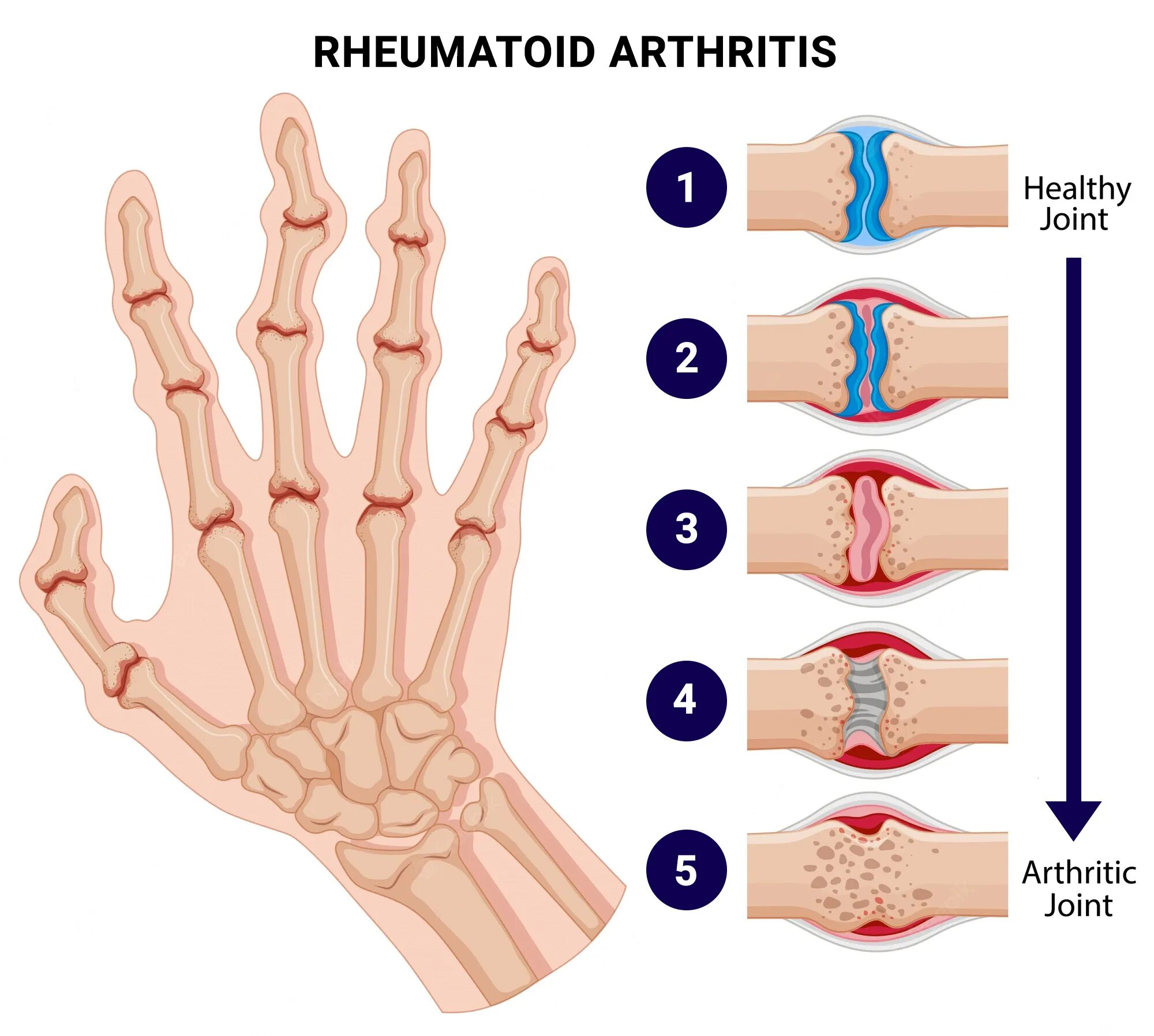 Polymyalgia Rheumatica Diet - YouTube