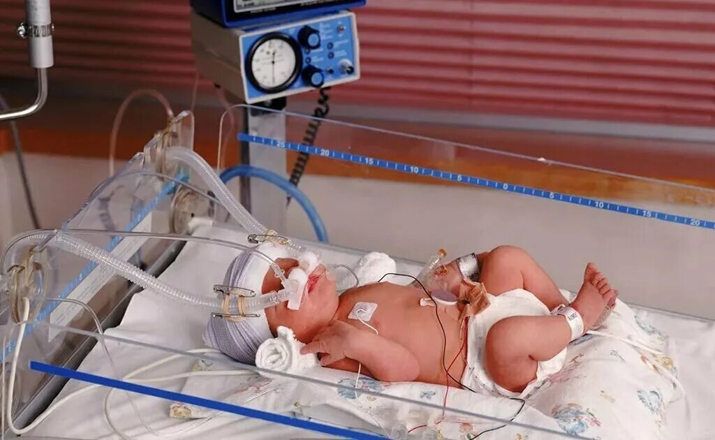 Песня недоношенный ребенок. Аппарат ИВЛ для новорожденных. Реанимация новорожденного. Новорожденные в реанимации.