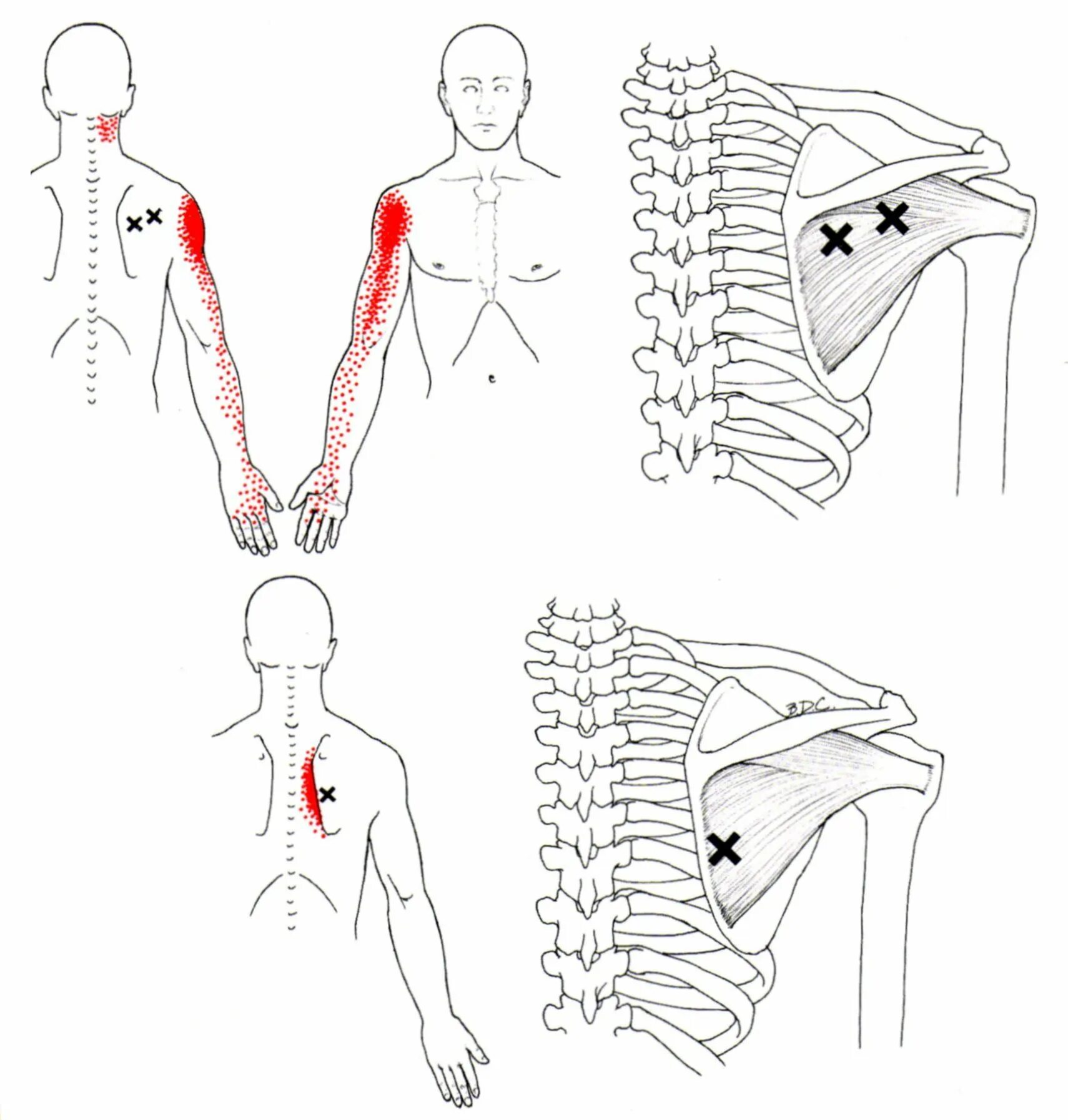 Плечи и поясница. Подостная мышца триггерные точки. Надостная мышца триггерные точки. Триггерные точки ромбовидной мышцы. Подостная мышца плеча триггерные точки.