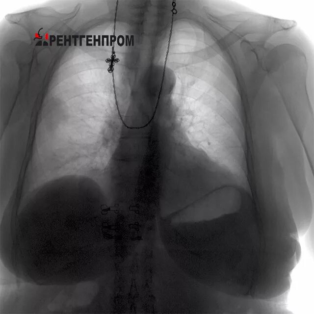 Рак на снимке флюорографии как выглядит Right Upper Lobe Lung Cancer with Rib Metastasis