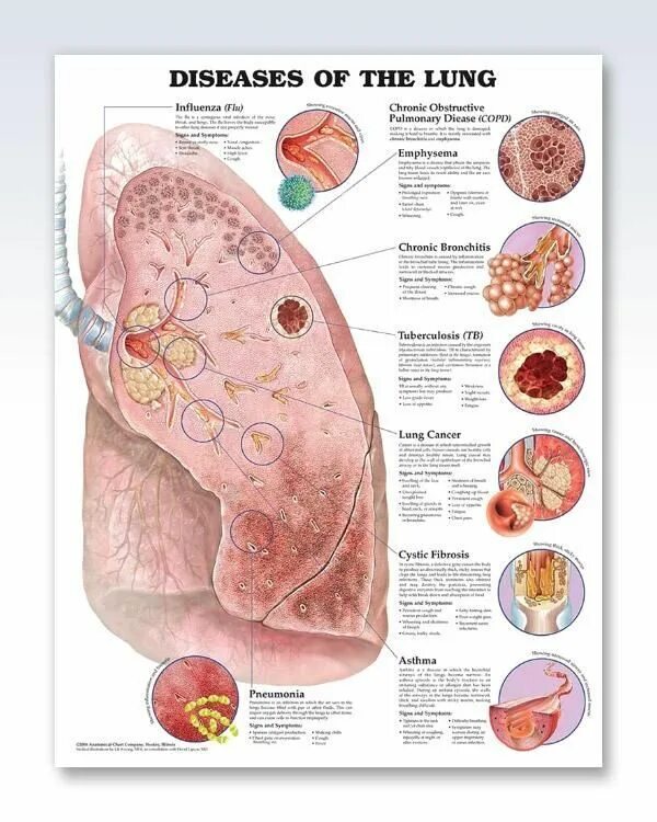 Lung disease. Дыхание легкие. Легкие анатомия плакат. Lung disease. Lung disease.