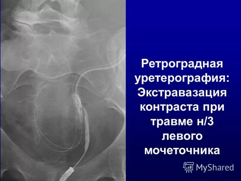 Поврежден мочеточник. Классификация повреждений мочеточника. Травмы мочеточника и почек урология. Травматические повреждения мочеточников. Поврежден мочеточник.