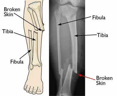 Open fracture