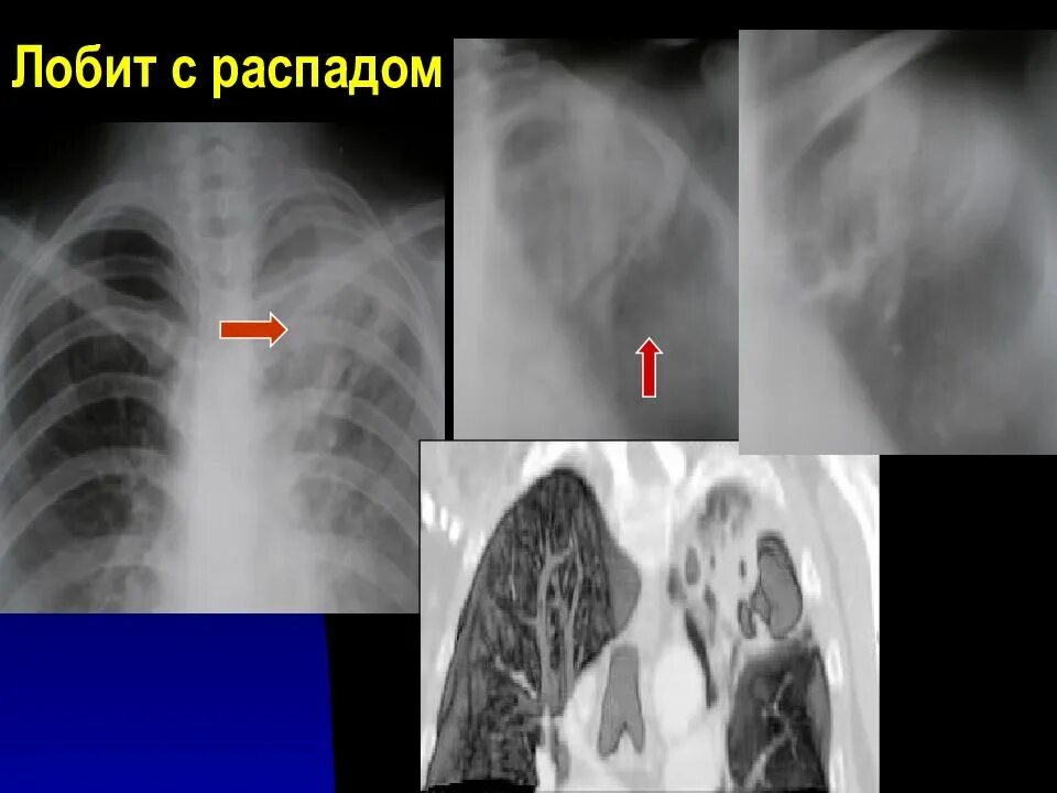 Лобить. Инфильтративный туберкулез Лобит рентген. ЛАБИТ инфильтративный туберкулез. Лобит при туберкулезе рентген.