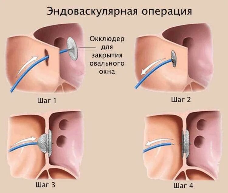 Не закрывается окно у новорожденных. Открытое овальное окошко у новорожденного. открытое овальное окно в сердце у новорожденного. открытое овальное окно операция. открытое овальное окно в сердце у новорожденного 2мм.