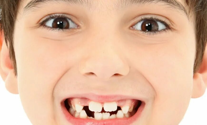 Детские передние зубы. Детские передние зубы. Детские передние зубы. Молочные зубы кт ребенка. Молочные зубы у детей.