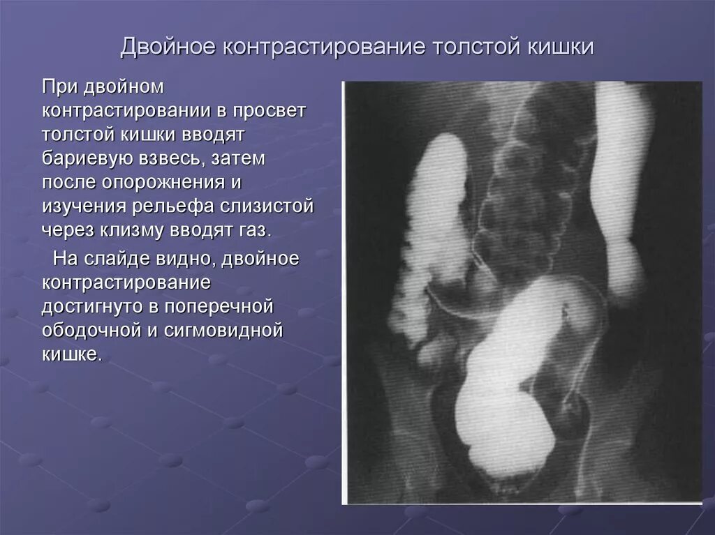 Исследование прямой и сигмовидной кишки. Первичное двойное контрастирование толстой кишки. Двойное контрастирование толстой кишки рентген. Контрастирование толстой кишки рентген. Двойное контрастирование Толстого кишечника.