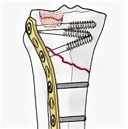 Остеосинтез мыщелков большеберцовой кости. Остеосинтез мыщелков большеберцовой кости пластиной. Остеосинтез мыщелка берцовой кости. Остеосинтез переломов мыщелков большеберцовой кости. Остеосинтез мыщелка