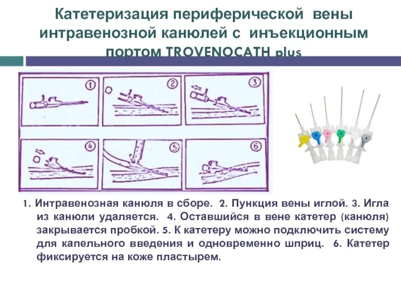 Катетеризация периферических вен алгоритм. Катетеризация периферической вены. Постановка периферического катетера. Пункция и катетеризация периферических вен. Места постановки периферического венозного катетера.