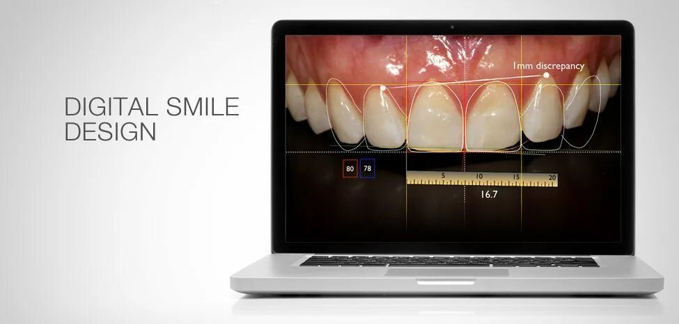 Смайл дизайн. Цифровой дизайн улыбки. dsd дизайн улыбки. dsd digital smile design.