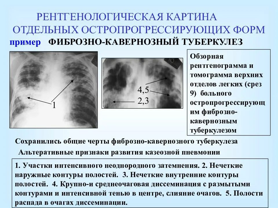 Стадия инфильтрации легких. Рентгенологический симптом фиброзно-кавернозного туберкулеза. фиброзно-кавернозный туберкулез рентген. фиброзно-кавернозный туберкулез легких рентген. фиброзно-кавернозный туберкулёз лёгких на рентгене.