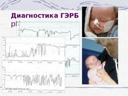 Рефлюкс у новорожденных