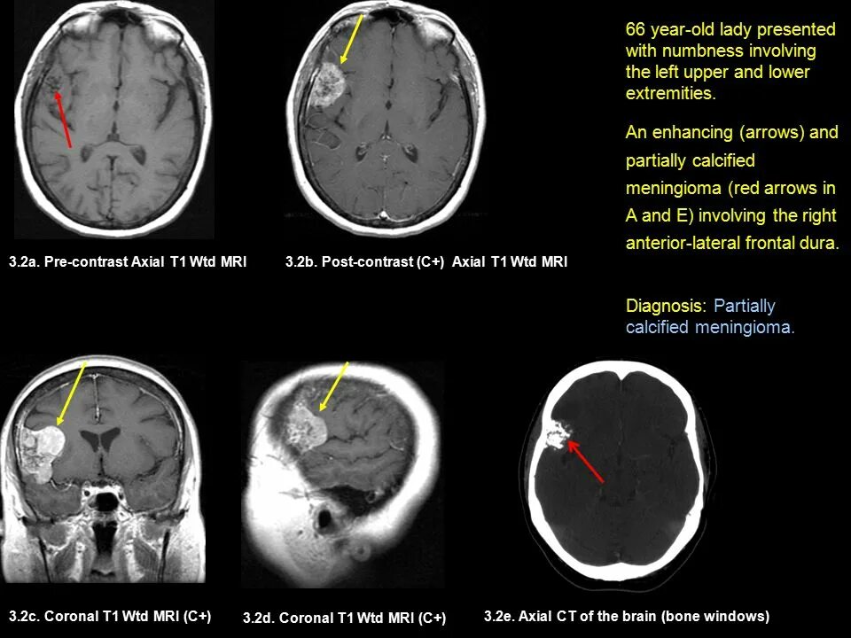 Менингиомы кавернозного синуса. Менингиома лобной доли мрт. Боли при менингиоме. Фалькс менингиома головного. Менингиома лобной доли слева.