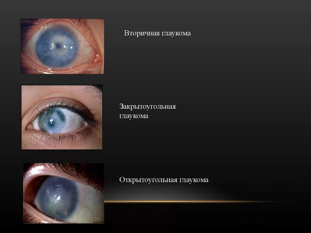 Глаукома глаза причины. Первичная открытоугольная глаукома симптомы. Закрытоугольная форма глаукомы. Открытоугольная глаукома глаз.