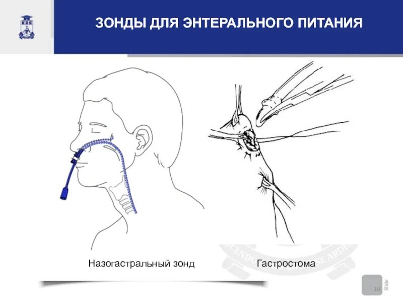 Зонд в нос. Назогастральный зонд. Назогастральный зонд постановка. Зонд для энтерального питания.