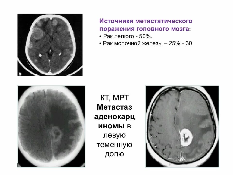 Рак молочной железы метастазы в легких