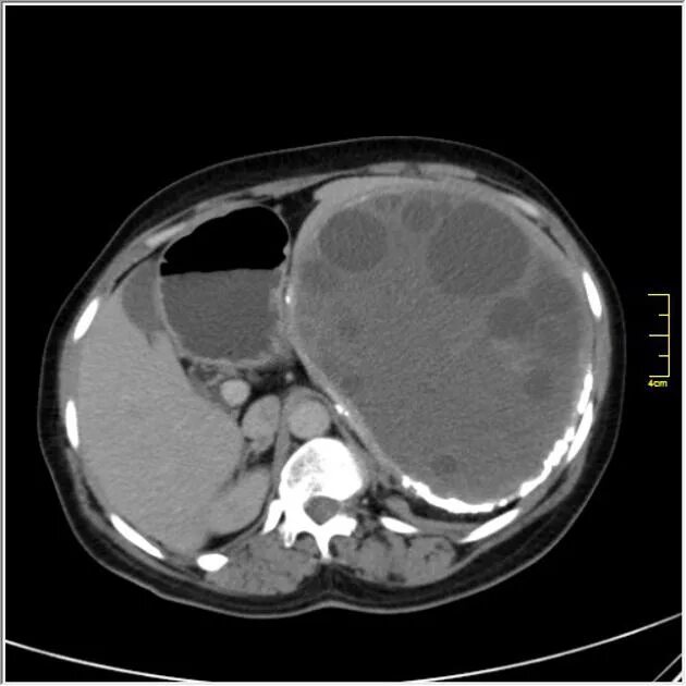Кисты печени и почек. Киста печени эхинококк кт. Эхинококковая киста почки кт.