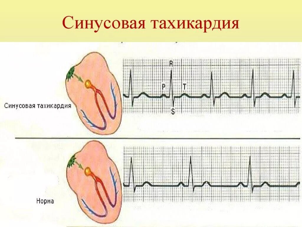 Сердце учащенное сердцебиение. Синусовая тахикардия ЭКГ ЭКГ. Синусовая тахикардия ЭКГ рисунок. Синусовая тахикардия ЧСС 100 ЭКГ. Синусовая тахикардия на ЭКГ.