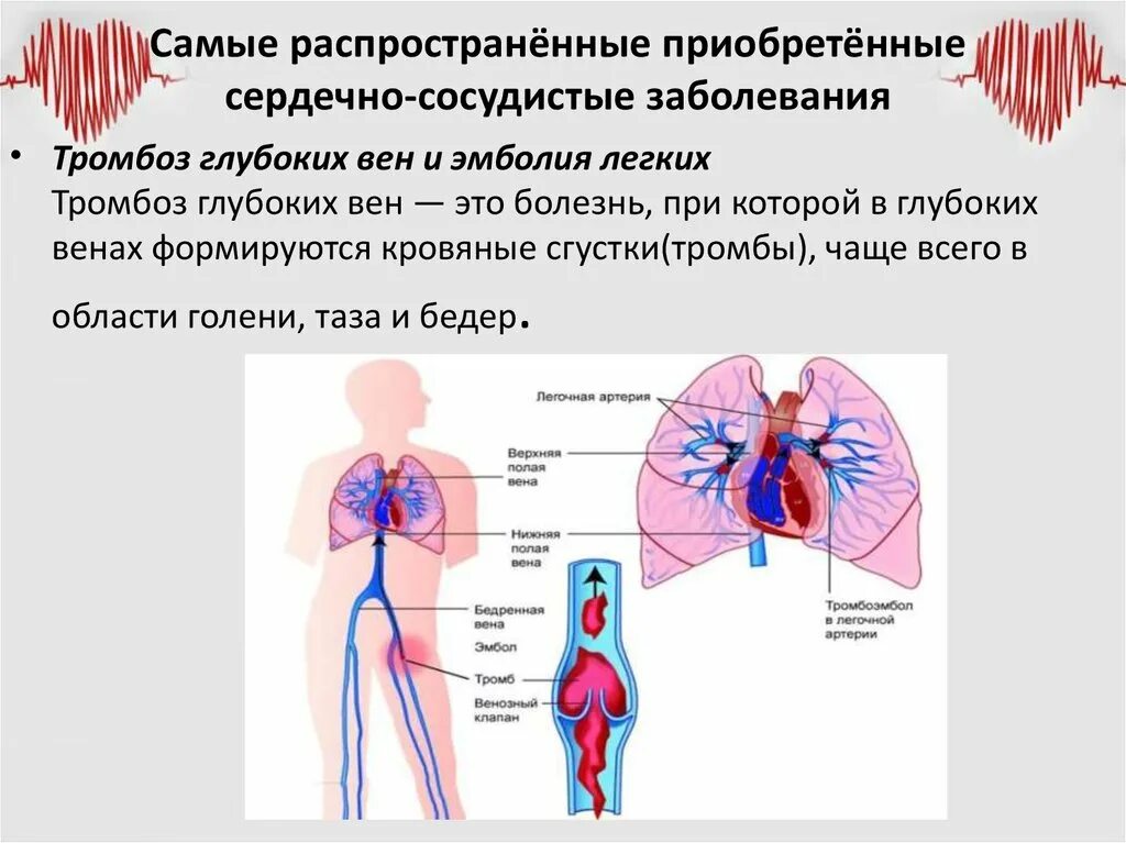 Распространенные заболевания сердечно сосудистой системы. Самые распространенные заболевания сердца. Наиболее распространённые заболевания сердечно-сосудистой системы. Распространенные системы заболевания сердца. Сердечный тромбоз